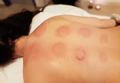 eutopia wellness center thesalloniki cupping massage